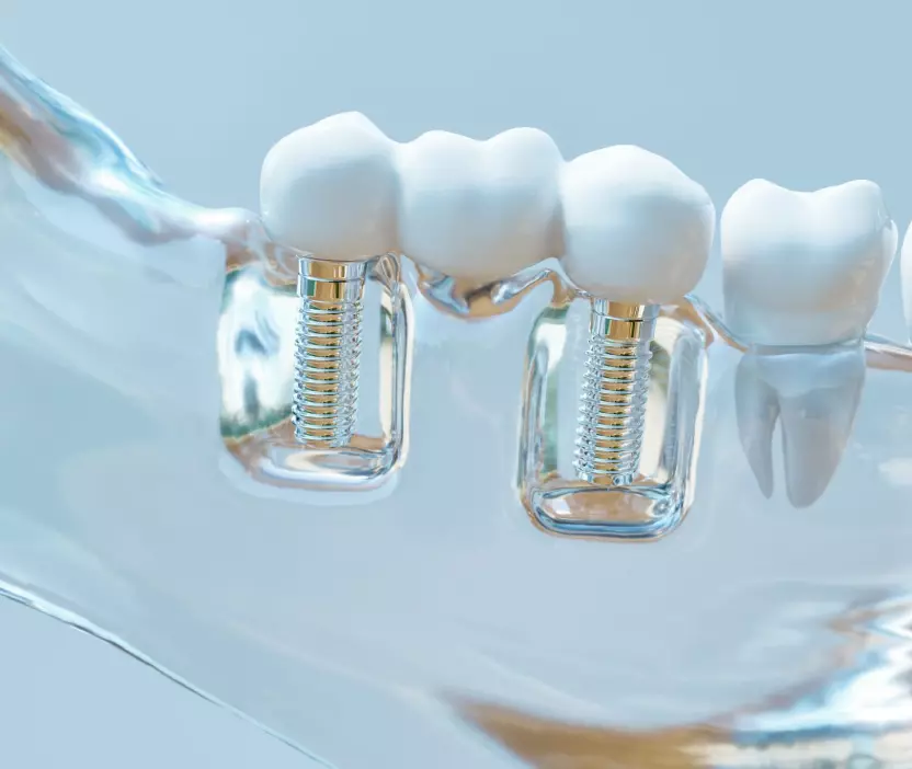 implant unitaire au cabinet dentaire du Dr Charles Malthieu