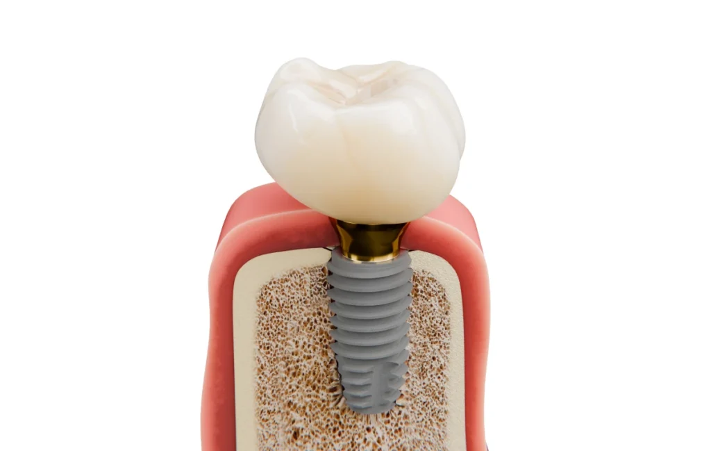 Implants dentaires : conseils post-opératoires