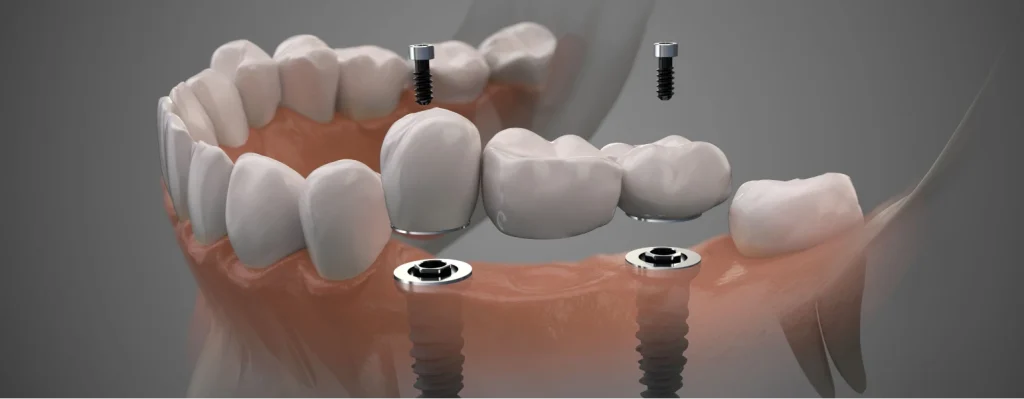 implant dentaire au cabinet dentaire du Dr Charles Malthieu