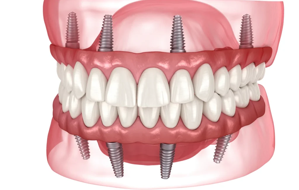 Le système ALL ON 4