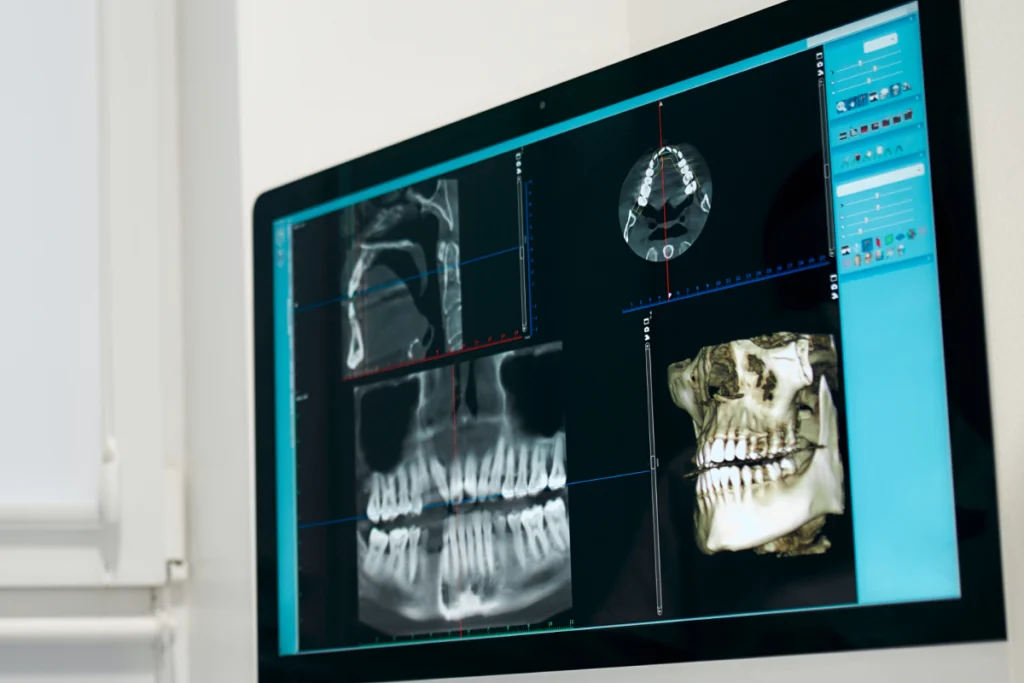 Réhabilitations complexes des maxillaires