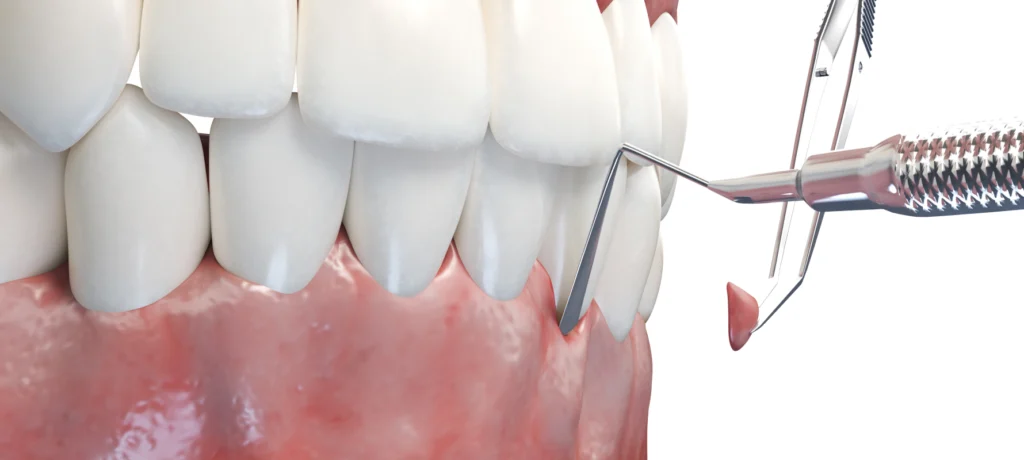 Chirurgie muco-gingivale